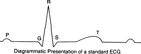 
The Electrocardiogram (ECG) : Impulse conduction generates tiny elect