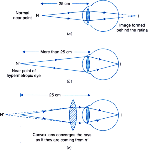 A What Is Hypermetropia B What Are The Two Causes Of This Defect Of Vision C How Can This Defect Of The Eye Be Corrected Illustrate Your Answer By Drawing Ray Diagram To Show