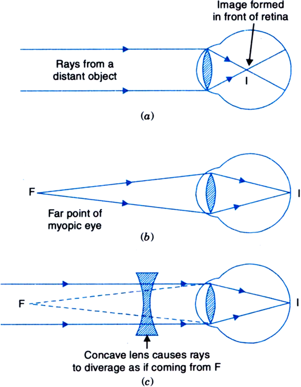 myopia correction diagram